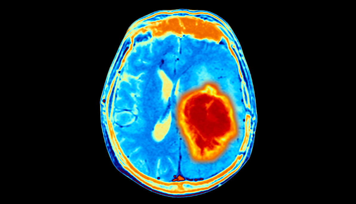 MRI of brain tumor