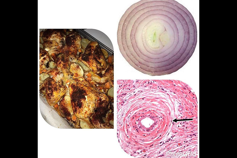 One Pan Chicken. The onion reminded Segelnick of primary sclerosing cholangitis—a disease that slowly damages the bile ducts.