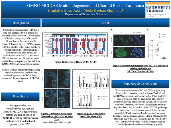 GMNC-MCIDAS Multiciologenesis and Choroid Plexus Carcinoma