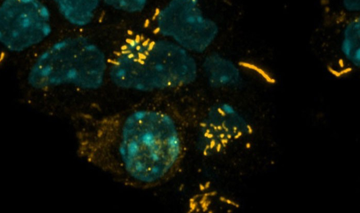 Choroid Plexus Tumors (Teal) receive a treatment to restore Multicilia (Yellow), which was shown to decrease tumor growth.